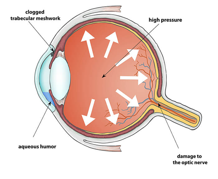 Chart Illustrating How Glaucoma Affects the Eye