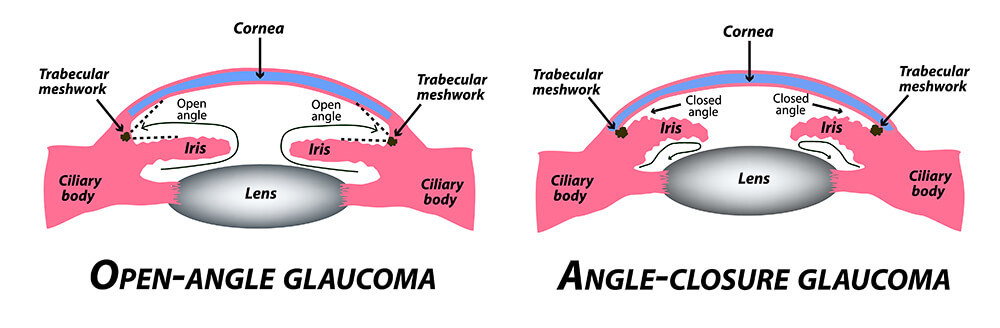 Glaucoma Types Chart