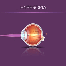 Hyperopia