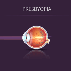 Presbyopia